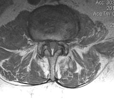 Lumbar MRI Axial Stenosis